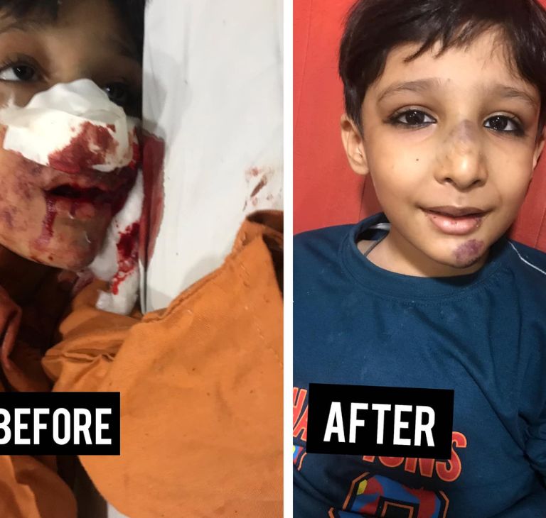 Low Dose Prophylaxis (LDP) Treatment